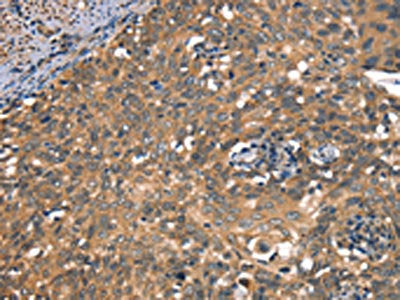 The image on the left is immunohistochemistry of paraffin-embedded Human cervical cancer tissue using CSB-PA184126(DAAM1 Antibody) at dilution 1/50, on the right is treated with synthetic peptide. (Original magnification: ×200)