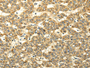 The image on the left is immunohistochemistry of paraffin-embedded Human liver cancer tissue using CSB-PA184142(WDR91 Antibody) at dilution 1/35, on the right is treated with synthetic peptide. (Original magnification: ×200)