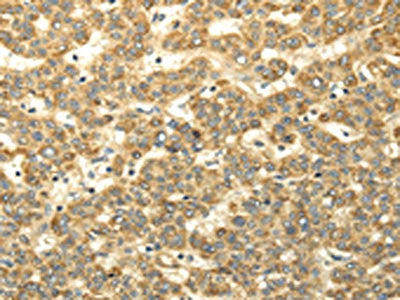 The image on the left is immunohistochemistry of paraffin-embedded Human liver cancer tissue using CSB-PA184142(WDR91 Antibody) at dilution 1/35, on the right is treated with synthetic peptide. (Original magnification: ×200)