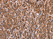 The image on the left is immunohistochemistry of paraffin-embedded Human gastic cancer tissue using CSB-PA184311(LILRB1 Antibody) at dilution 1/50, on the right is treated with fusion protein. (Original magnification: ×200)