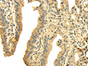 The image on the left is immunohistochemistry of paraffin-embedded Human thyroid cancer tissue using CSB-PA184426(PTGS2 Antibody) at dilution 1/40, on the right is treated with fusion protein. (Original magnification: ×200)