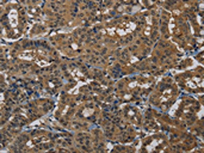 The image on the left is immunohistochemistry of paraffin-embedded Human thyroid cancer tissue using CSB-PA184660(PNN Antibody) at dilution 1/50, on the right is treated with synthetic peptide. (Original magnification: ×200)
