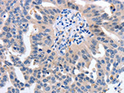 The image on the left is immunohistochemistry of paraffin-embedded Human ovarian cancer tissue using CSB-PA184783(YWHAQ Antibody) at dilution 1/50, on the right is treated with synthetic peptide. (Original magnification: ×200)
