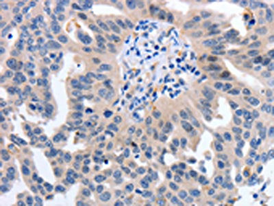 The image on the left is immunohistochemistry of paraffin-embedded Human ovarian cancer tissue using CSB-PA184783(YWHAQ Antibody) at dilution 1/50, on the right is treated with synthetic peptide. (Original magnification: ×200)
