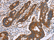 The image on the left is immunohistochemistry of paraffin-embedded Human colon cancer tissue using CSB-PA184980(PDLIM1 Antibody) at dilution 1/30, on the right is treated with fusion protein. (Original magnification: ×200)