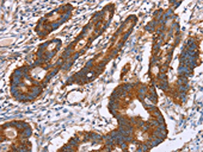 The image on the left is immunohistochemistry of paraffin-embedded Human colon cancer tissue using CSB-PA184980(PDLIM1 Antibody) at dilution 1/30, on the right is treated with fusion protein. (Original magnification: ×200)