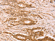 The image on the left is immunohistochemistry of paraffin-embedded Human colon cancer tissue using CSB-PA185143(STRA8 Antibody) at dilution 1/25, on the right is treated with synthetic peptide. (Original magnification: ×200)
