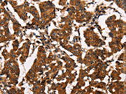 The image on the left is immunohistochemistry of paraffin-embedded Human breast cancer tissue using CSB-PA185232(ATRN Antibody) at dilution 1/50, on the right is treated with synthetic peptide. (Original magnification: ×200)