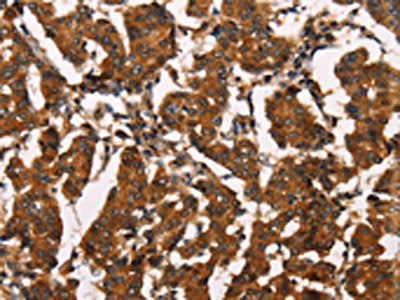 The image on the left is immunohistochemistry of paraffin-embedded Human breast cancer tissue using CSB-PA185232(ATRN Antibody) at dilution 1/50, on the right is treated with synthetic peptide. (Original magnification: ×200)
