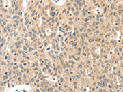 The image on the left is immunohistochemistry of paraffin-embedded Human ovarian cancer tissue using CSB-PA185342(ROS1 Antibody) at dilution 1/40, on the right is treated with synthetic peptide. (Original magnification: ×200)