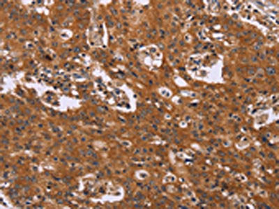 The image on the left is immunohistochemistry of paraffin-embedded Human gastric cancer tissue using CSB-PA185437(CMTM6 Antibody) at dilution 1/40, on the right is treated with synthetic peptide. (Original magnification: ×200)