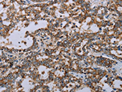 The image on the left is immunohistochemistry of paraffin-embedded Human liver cancer tissue using CSB-PA185762(MMP23B Antibody) at dilution 1/20, on the right is treated with synthetic peptide. (Original magnification: ×200)