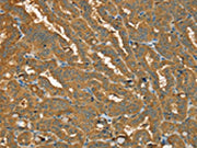 The image on the left is immunohistochemistry of paraffin-embedded Human thyroid cancer tissue using CSB-PA185772(PYGL Antibody) at dilution 1/20, on the right is treated with fusion protein. (Original magnification: ×200)