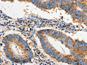 The image on the left is immunohistochemistry of paraffin-embedded Human colon cancer tissue using CSB-PA185779(FAS Antibody) at dilution 1/60, on the right is treated with fusion protein. (Original magnification: ×200)