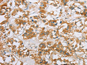The image on the left is immunohistochemistry of paraffin-embedded Human thyroid cancer tissue using CSB-PA186108(CYP2E1 Antibody) at dilution 1/35, on the right is treated with fusion protein. (Original magnification: ×200)