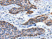 The image on the left is immunohistochemistry of paraffin-embedded Human esophagus cancer tissue using CSB-PA186529(AQP8 Antibody) at dilution 1/75, on the right is treated with synthetic peptide. (Original magnification: ×200)