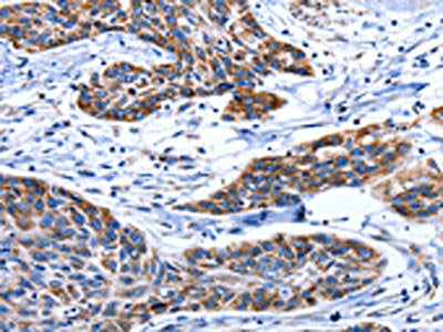 The image on the left is immunohistochemistry of paraffin-embedded Human esophagus cancer tissue using CSB-PA186529(AQP8 Antibody) at dilution 1/75, on the right is treated with synthetic peptide. (Original magnification: ×200)