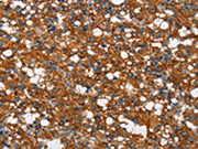 The image on the left is immunohistochemistry of paraffin-embedded Human thyroid cancer tissue using CSB-PA186754(COX5A Antibody) at dilution 1/40, on the right is treated with synthetic peptide. (Original magnification: ×200)