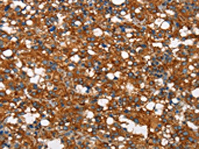 The image on the left is immunohistochemistry of paraffin-embedded Human thyroid cancer tissue using CSB-PA186754(COX5A Antibody) at dilution 1/40, on the right is treated with synthetic peptide. (Original magnification: ×200)
