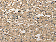 The image on the left is immunohistochemistry of paraffin-embedded Human thyroid cancer tissue using CSB-PA186785(ALDH8A1 Antibody) at dilution 1/30, on the right is treated with fusion protein. (Original magnification: ×200)