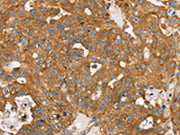 The image on the left is immunohistochemistry of paraffin-embedded Human breast cancer tissue using CSB-PA186945(TPD52L2 Antibody) at dilution 1/20, on the right is treated with synthetic peptide. (Original magnification: ×200)