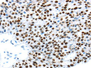 The image on the left is immunohistochemistry of paraffin-embedded Human breast cancer tissue using CSB-PA186952(UBA1 Antibody) at dilution 1/30, on the right is treated with synthetic peptide. (Original magnification: x200)