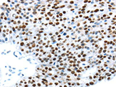 The image on the left is immunohistochemistry of paraffin-embedded Human breast cancer tissue using CSB-PA186952(UBA1 Antibody) at dilution 1/30, on the right is treated with synthetic peptide. (Original magnification: x200)