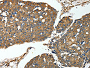 The image on the left is immunohistochemistry of paraffin-embedded Human breast cancer tissue using CSB-PA187078(MSN Antibody) at dilution 1/30, on the right is treated with fusion protein. (Original magnification: ×200)