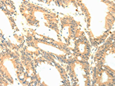 The image on the left is immunohistochemistry of paraffin-embedded Human colon cancer tissue using CSB-PA187176(PTGES3 Antibody) at dilution 1/50, on the right is treated with fusion protein. (Original magnification: ×200)