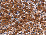 The image on the left is immunohistochemistry of paraffin-embedded Human gastic cancer tissue using CSB-PA187322(HMGCS2 Antibody) at dilution 1/40, on the right is treated with synthetic peptide. (Original magnification: ×200)
