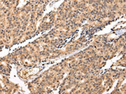 The image on the left is immunohistochemistry of paraffin-embedded Human prostate cancer tissue using CSB-PA187364(SWAP70 Antibody) at dilution 1/20, on the right is treated with fusion protein. (Original magnification: ×200)