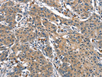 The image on the left is immunohistochemistry of paraffin-embedded Human gastic cancer tissue using CSB-PA187613(OLR1 Antibody) at dilution 1/25, on the right is treated with synthetic peptide. (Original magnification: ×200)
