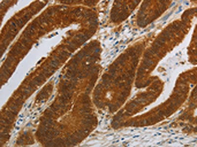 The image on the left is immunohistochemistry of paraffin-embedded Human colon cancer tissue using CSB-PA187627(NIT2 Antibody) at dilution 1/40, on the right is treated with synthetic peptide. (Original magnification: ×200)