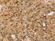 The image on the left is immunohistochemistry of paraffin-embedded Human breast cancer tissue using CSB-PA187654(MED22 Antibody) at dilution 1/50, on the right is treated with fusion protein. (Original magnification: ×200)
