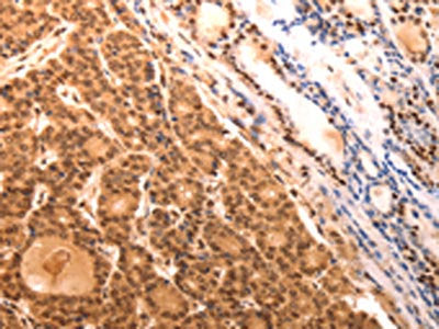 The image on the left is immunohistochemistry of paraffin-embedded Human thyroid cancer tissue using CSB-PA187673(SERPINC1 Antibody) at dilution 1/15, on the right is treated with fusion protein. (Original magnification: ×200)