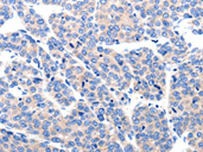 The image on the left is immunohistochemistry of paraffin-embedded Human ovarian cancer tissue using CSB-PA187759(KCNH8 Antibody) at dilution 1/50, on the right is treated with synthetic peptide. (Original magnification: ×200)