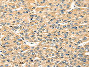 The image on the left is immunohistochemistry of paraffin-embedded Human liver cancer tissue using CSB-PA188001(STX18 Antibody) at dilution 1/20, on the right is treated with fusion protein. (Original magnification: ×200)