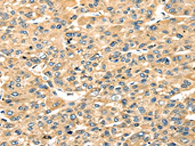 The image on the left is immunohistochemistry of paraffin-embedded Human liver cancer tissue using CSB-PA188001(STX18 Antibody) at dilution 1/20, on the right is treated with fusion protein. (Original magnification: ×200)