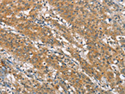 The image on the left is immunohistochemistry of paraffin-embedded Human gastic cancer tissue using CSB-PA188045(NLRP7 Antibody) at dilution 1/40, on the right is treated with synthetic peptide. (Original magnification: ×200)