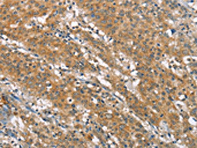 The image on the left is immunohistochemistry of paraffin-embedded Human gastic cancer tissue using CSB-PA188045(NLRP7 Antibody) at dilution 1/40, on the right is treated with synthetic peptide. (Original magnification: ×200)