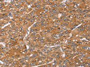 The image on the left is immunohistochemistry of paraffin-embedded Human liver cancer tissue using CSB-PA188142(PAICS Antibody) at dilution 1/35, on the right is treated with fusion protein. (Original magnification: ×200)