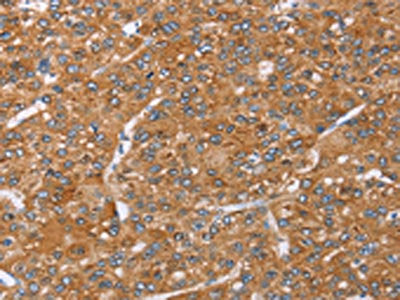 The image on the left is immunohistochemistry of paraffin-embedded Human liver cancer tissue using CSB-PA188142(PAICS Antibody) at dilution 1/35, on the right is treated with fusion protein. (Original magnification: ×200)