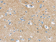 The image on the left is immunohistochemistry of paraffin-embedded Human brain tissue using CSB-PA188240(VAMP1 Antibody) at dilution 1/25, on the right is treated with synthetic peptide. (Original magnification: ×200)