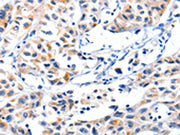 The image on the left is immunohistochemistry of paraffin-embedded Human lung cancer tissue using CSB-PA188267(FBLN5 Antibody) at dilution 1/85, on the right is treated with synthetic peptide. (Original magnification: ×200)