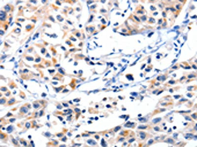 The image on the left is immunohistochemistry of paraffin-embedded Human lung cancer tissue using CSB-PA188267(FBLN5 Antibody) at dilution 1/85, on the right is treated with synthetic peptide. (Original magnification: ×200)