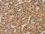 The image on the left is immunohistochemistry of paraffin-embedded Human liver cancer tissue using CSB-PA188638(CXCR6 Antibody) at dilution 1/20, on the right is treated with fusion protein. (Original magnification: ×200)