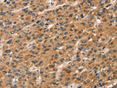 The image on the left is immunohistochemistry of paraffin-embedded Human liver cancer tissue using CSB-PA188638(CXCR6 Antibody) at dilution 1/20, on the right is treated with fusion protein. (Original magnification: ×200)