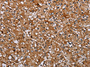 The image on the left is immunohistochemistry of paraffin-embedded Human prostate cancer tissue using CSB-PA188650(ATP2A1 Antibody) at dilution 1/35, on the right is treated with synthetic peptide. (Original magnification: ×200)