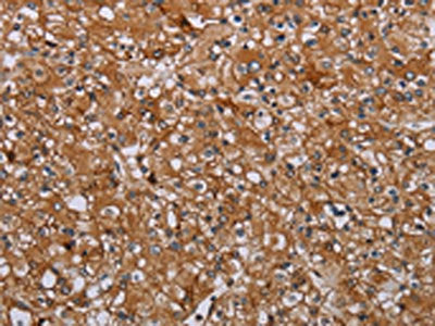 The image on the left is immunohistochemistry of paraffin-embedded Human prostate cancer tissue using CSB-PA188650(ATP2A1 Antibody) at dilution 1/35, on the right is treated with synthetic peptide. (Original magnification: ×200)