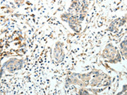 The image on the left is immunohistochemistry of paraffin-embedded Human cervical cancer tissue using CSB-PA188693(FZD3 Antibody) at dilution 1/20, on the right is treated with synthetic peptide. (Original magnification: ×200)
